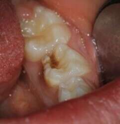 dent sans coiffes préformées