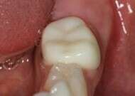 dent avec coiffes préformées