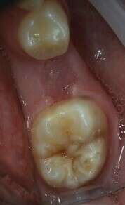 comblement sillon avant