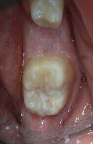 comblement sillon après