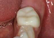 dent avec coiffes préformées