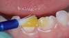 application vernis fluoré