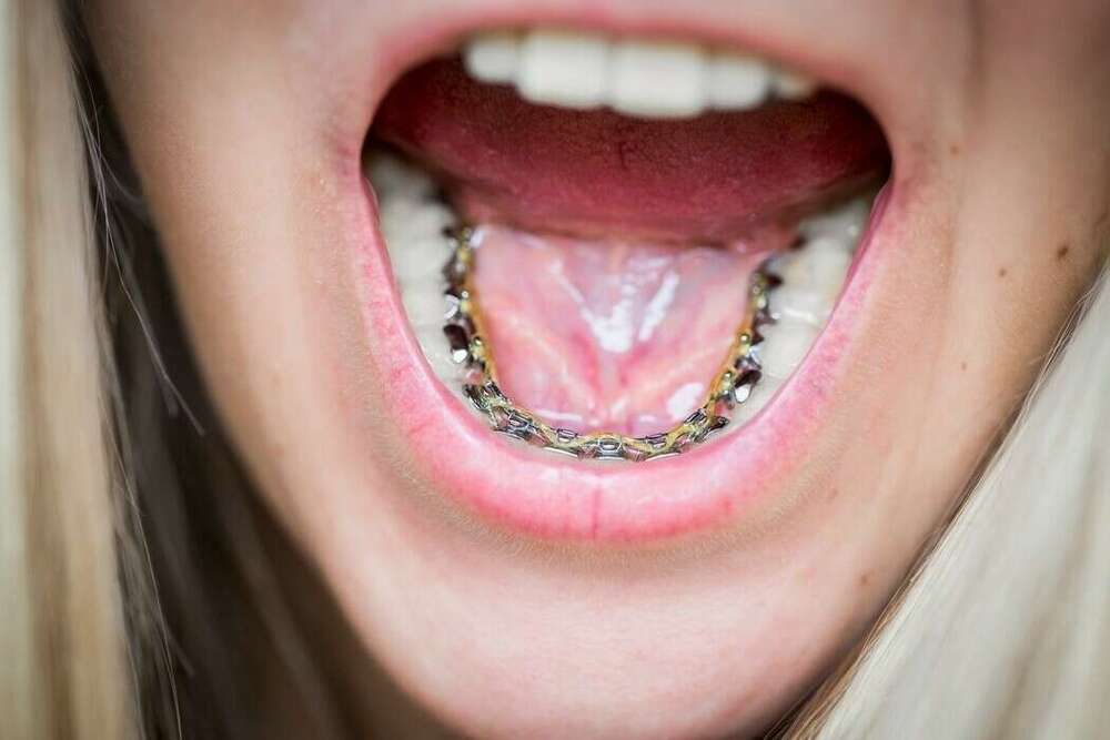 LES SEPT FAMILLES D’APPAREILLAGES ORTHODONTIQUES