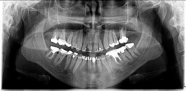 CAS 1 : CANINE INCLUSE CHEZ L'ADULTE