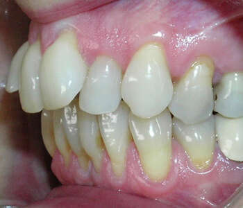 CAS 2 : INCISIVES TROP AVANCEES