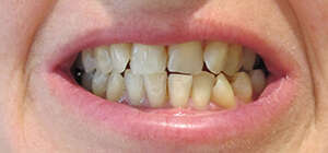 CAS 6 : ENCOMBREMENT ET ARTICULE INVERSE