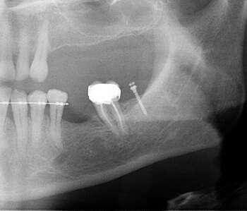 CAS 1 : REDRESSEMENT D'UNE MOLAIRE MESIOVERSEE