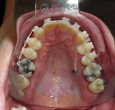 CAS 3 : RECENTRAGE DE LA MEDIANE MAXILLAIRE