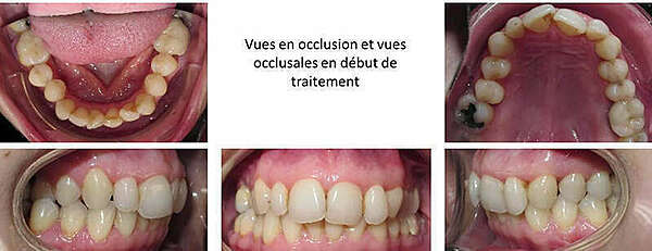 CAS 1: ENCOMBREMENT ET SURPLOMB