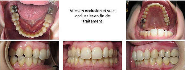 CAS 1 : ORTHODONTIE ET RACINES COURTES