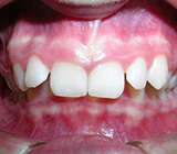 DECALAGE DES MACHOIRES ET RECOUVREMENT INCISIF EXCESSIF