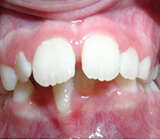 TRAITEMENT PRECOCE D'UN DECALAGE DES MACHOIRES