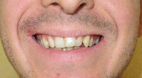 CAS 7 : RECENTRAGE DU MILIEU INTER INCISIF