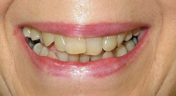 ALIGNEMENT AVANT LA POSE D'UN IMPLANT INCISIF MAXILLAIRE SUR UN PARODONTE REDUIT