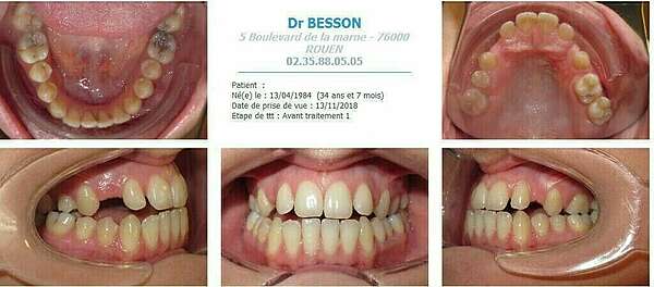 AMENAGEMENT D'ESPACES DANS LE CAS D'AGENESIES MULTIPLES