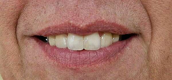 Cas 9 : Fermeture d'un diastème inter-incisif