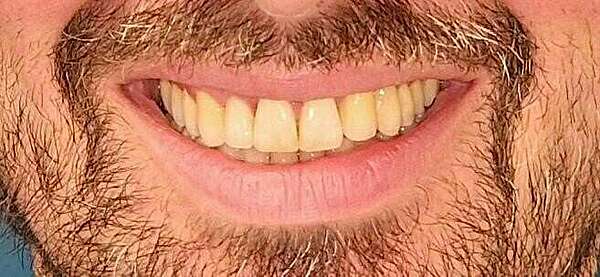 Cas 10 : Orthodontie pré-prothétique