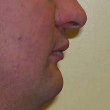 MACHOIRE INFERIEURE EN RETRAIT ET INCISVES SUPERIEURES AVANCEES