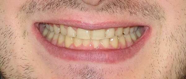 MACHOIRE INFERIEURE EN RETRAIT