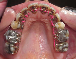 CAS 4 : ASYMETRIE DES MACHOIRES