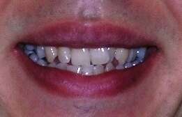 CAS 5 : ARCADE MAXILLAIRE TROP ETROITE