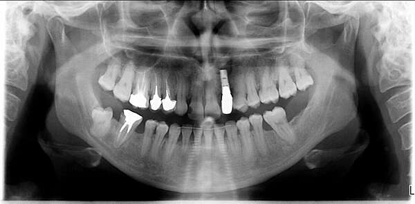 CAS 1 : AMENAGEMENT D'UN ESPACE POUR REMPLACER UNE CANINE SUPERIEURE ABSENTE