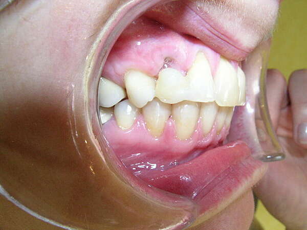 CAS 4 : ORTHODONTIE AVANT LE REMPLACEMENT D'UNE CANINE DELABREE