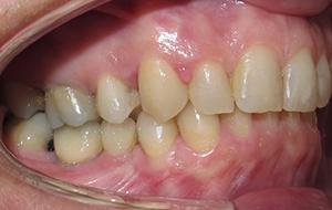 CAS 5 : AMENAGEMENT D'UN ESPACE DANS LE SENS VERTICAL AVANT LA POSE DE COURONNES SUR IMPLANTS