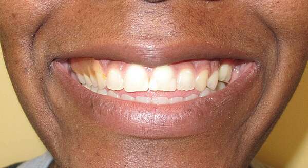 AMENAGEMENT D'ESPACE POUR REMPLACER 3 PREMOLAIRES ET FERMER UNE BEANCE