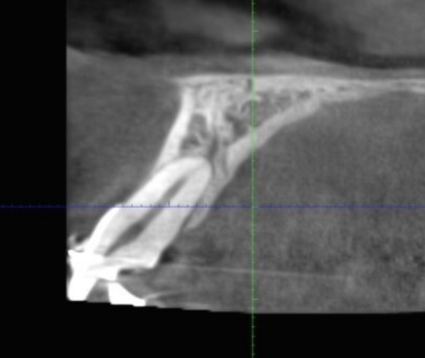 Cas 1 : syndrome du fil au niveau d'une incisive maxillaire