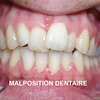 malposition dentaire