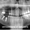 orthodontie et implants