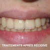 traitements après récidive
