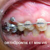 orthodontie et mini vis
