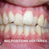 malpositions dentaires