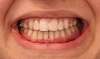 sourire avec les gouttieres et les facettes