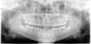 Radiographie panoramique de fin de traitement