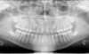 Radiologie panoramique de début de traitement