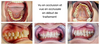Jeune femme bénéficiant traitement orthodontique par aligneurs