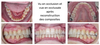 jeune femme 22 ans traitement aligneurs orthodontie
