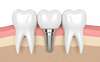 Implant dentaire