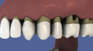 Brossette interdentaire et parodontite