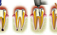 LE RETRAITEMENT ENDODONTIQUE