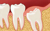 LES DENTS DE SAGESSE