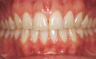 L’OCCLUSION DENTAIRE