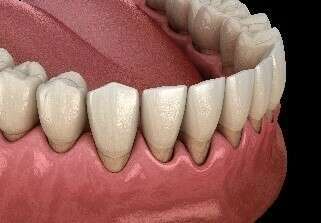 LES PARODONTITES (DÉCHAUSSEMENT DES DENTS)