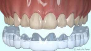 Eclaircissement ambulatoire