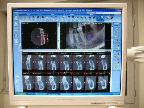 L'ANALYSE PRÉ-IMPLANTAIRE