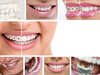 orthodontie, avant et après