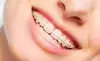 Appareil multi-bagues esthétique à bagues transparentes, orthodontie de l'adolescent à Douvaine